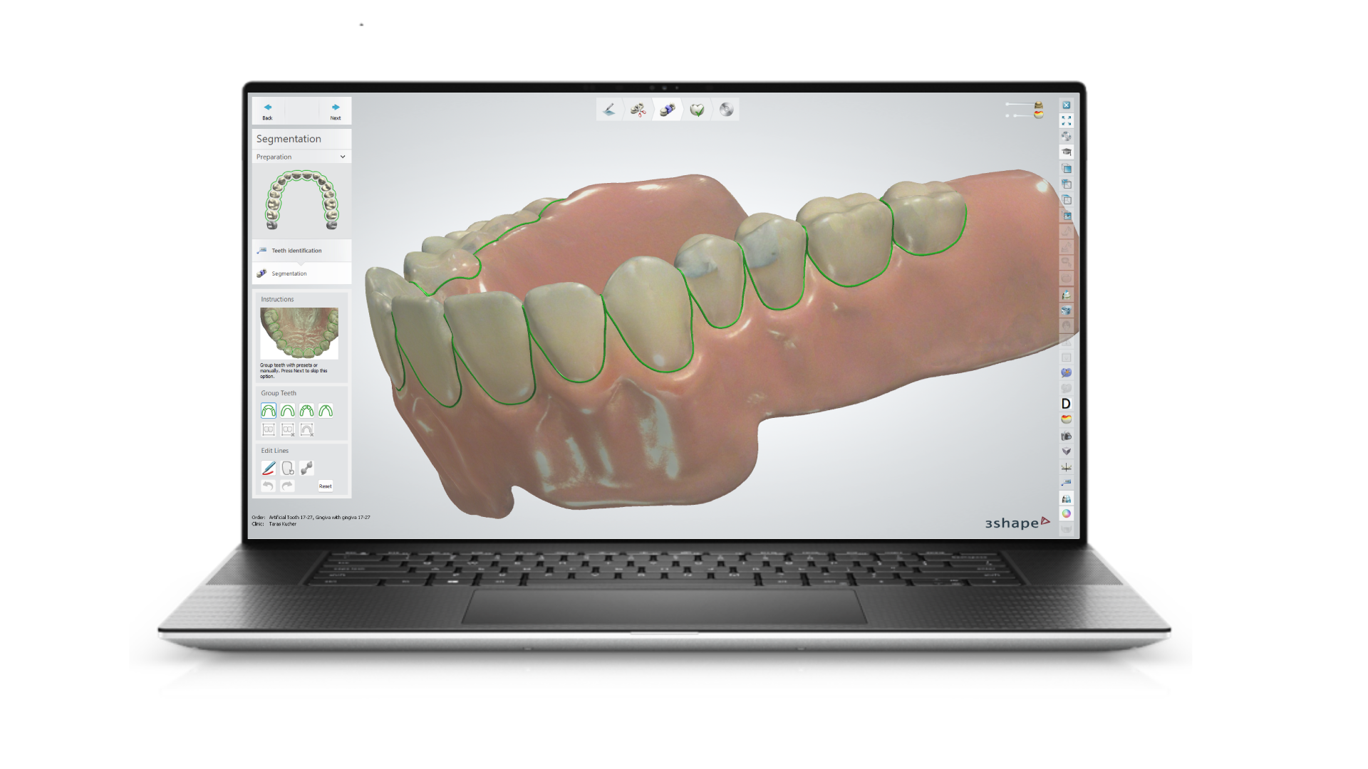 3D dental modeling segmentation interface