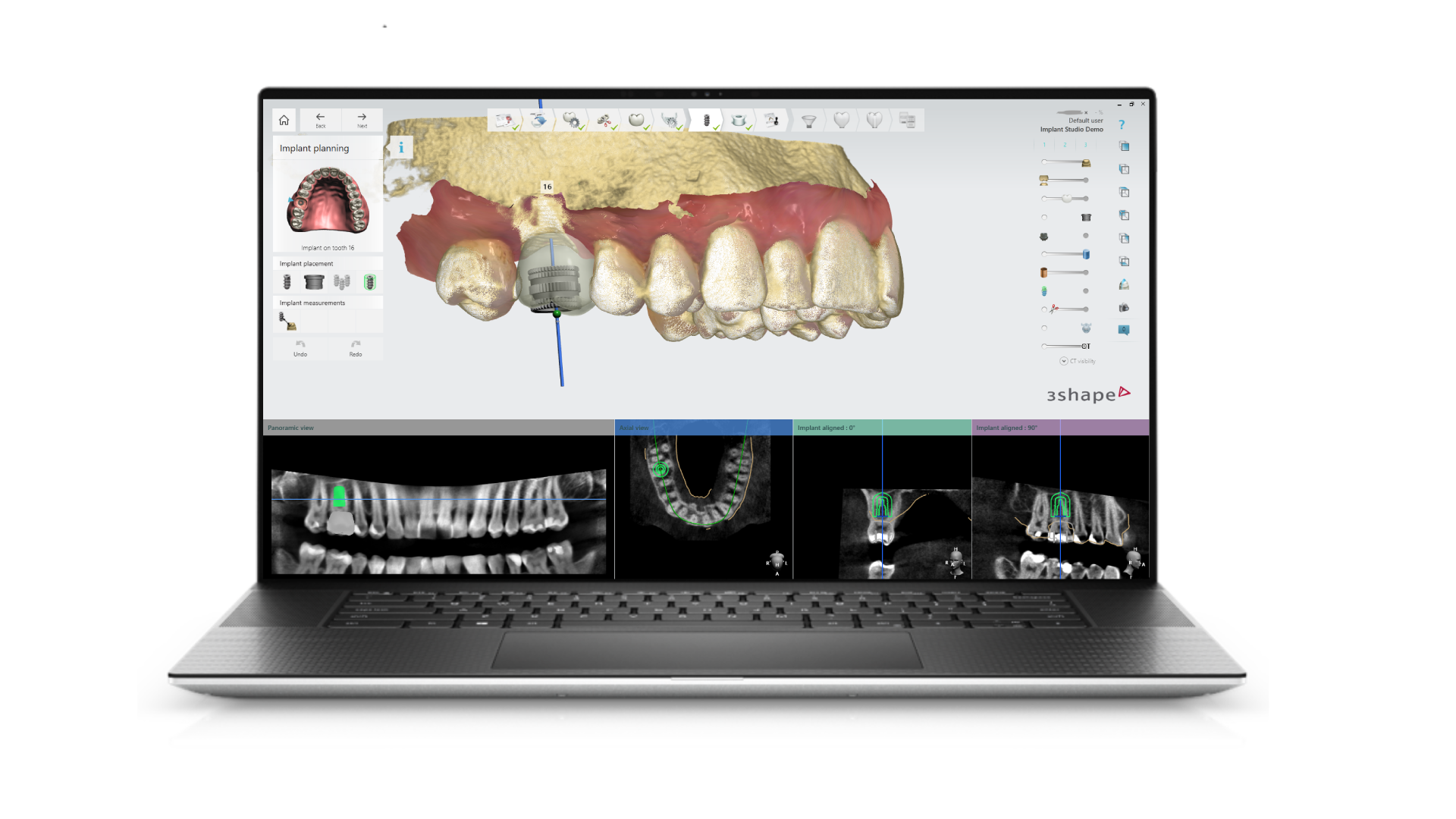 3D dental implant planning interface